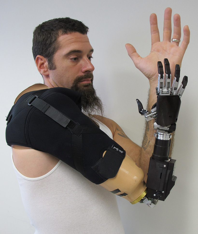 Powered Prosthetic Arm Shirley Ryan Abilitylab 